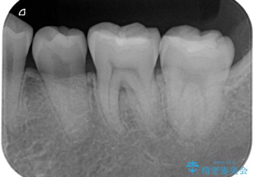 昔治した歯の形が気になる　セラミックインレーでキレイな歯に!の治療前