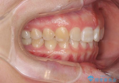 ねじれた前歯を改善するマウスピース矯正の治療後