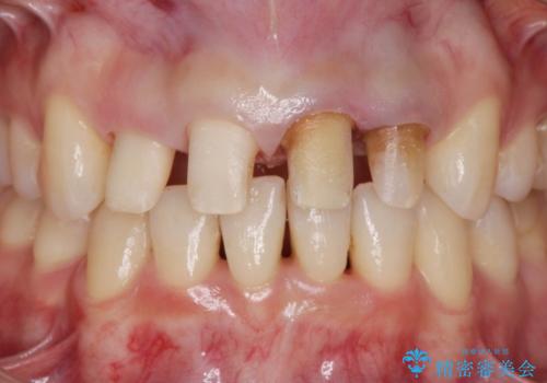 変色した歯を改善、セラミック治療の治療中