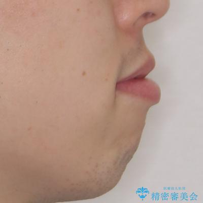 しゃくれて口が閉じられない ワイヤー装置での抜歯矯正の治療前(顔貌)