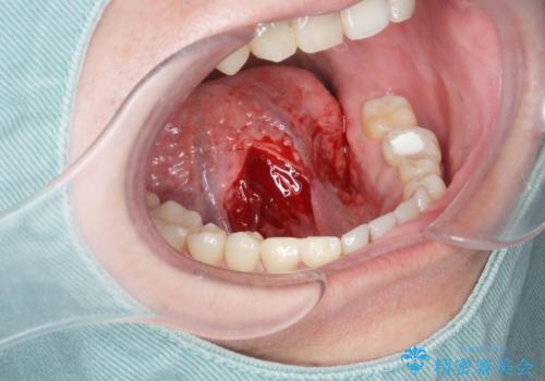 [ 舌小帯の形成術 ]  短い舌の改善をしたいの治療中