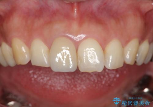 折れてしまった前歯   オールセラミックによる審美改善の治療後