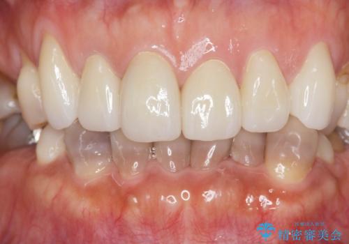 [ テトラサイクリン歯 ] 長年気になっていた変色歯を改善の治療後
