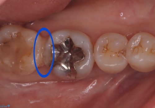 歯と歯の間に物がよく詰まるの治療前