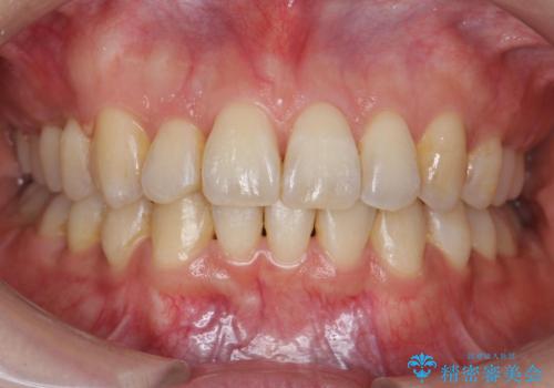 やや難ケース　上の歯を抜かずに歯列を後ろに下げて治療　4本ではなく下1本のみの抜歯できれいにの治療後