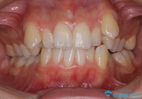 ワイヤー矯正　抜歯本数を最小限にし、八重歯のない歯並びに　の症例 治療前