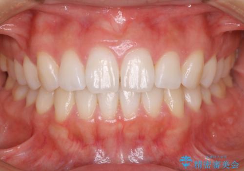 インビザライン矯正　前歯のすきっ歯を治したいの症例 治療後