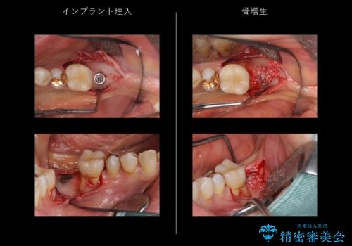 奥歯のインプラント 永くもつようにの治療中