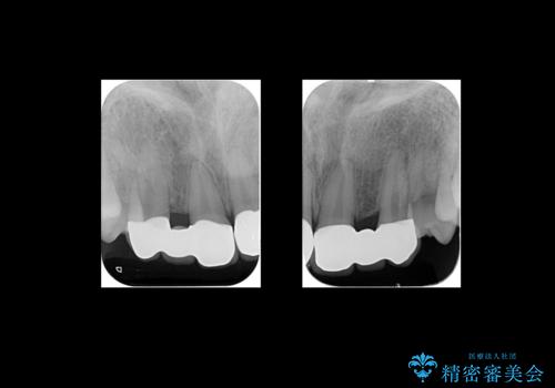 前歯のすきま　生まれつき歯が少ないのを治療の治療後