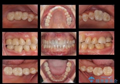 全体的な虫歯治療 他院で入れたインプラントの続きもの治療後