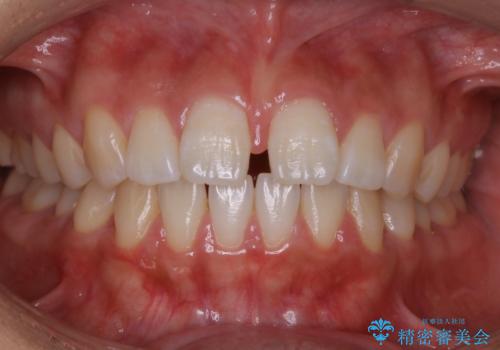 インビザライン矯正　前歯のすきっ歯を治したいの症例 治療前