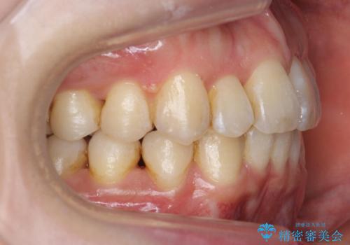 やや難ケース 上の歯を抜かずに歯列を後ろに下げて治療 4本ではなく下1本のみの抜歯できれいにの治療後
