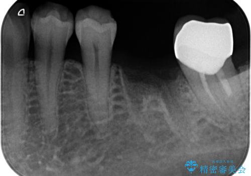歯の破折　食べる喜びが蘇るインプラント治療の治療前