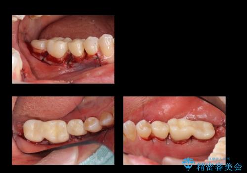 奥歯の高さがない 歯周外科で解決の治療中