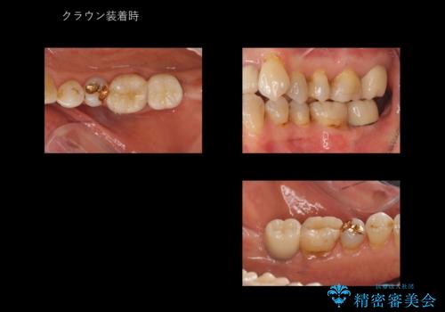 奥歯のインプラント 永くもつようにの治療後