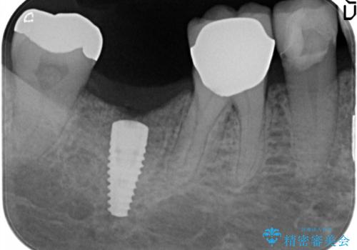 60代女性 奥歯のインプラント の治療中