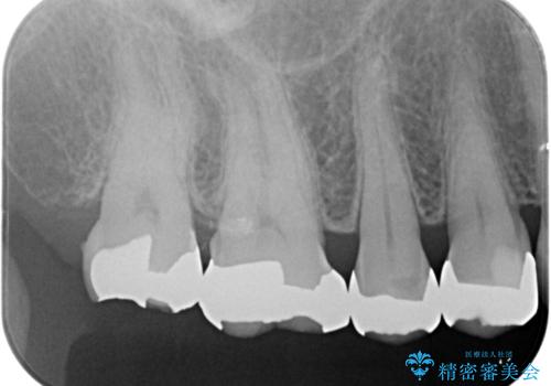 歯が欠けた　金属による割れない修復の治療前