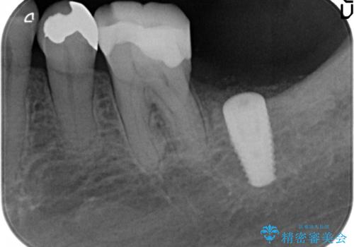 奥歯のインプラント 永くもつようにの治療中