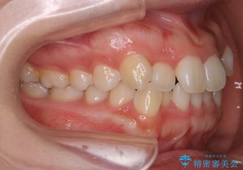 インビザライン矯正 短期間でがたつきのない歯並びに!の治療前