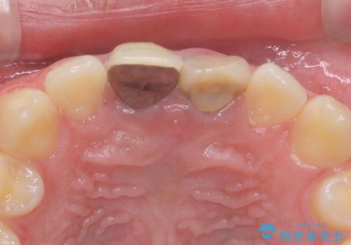 前歯の変色 神経のない歯の再治療の治療前