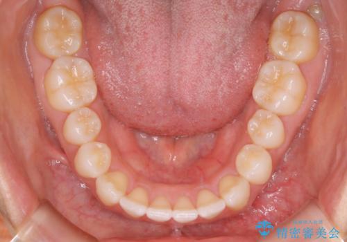インビザライン矯正 前歯のすきっ歯を治したいの治療後