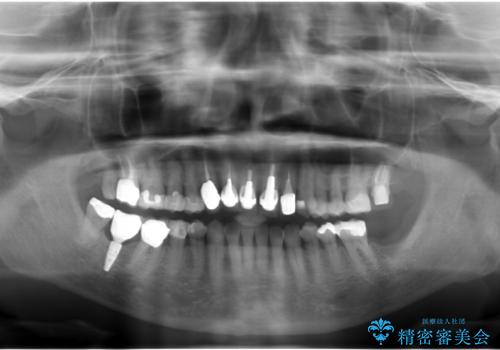60代女性 奥歯のインプラント の治療後
