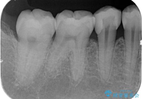 歯と歯の間の虫歯　セラミックインレーでの修復処置の治療後