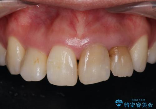 変色した歯を改善、セラミック治療の治療前