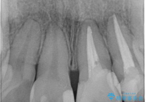 変色した歯を改善、セラミック治療の治療前