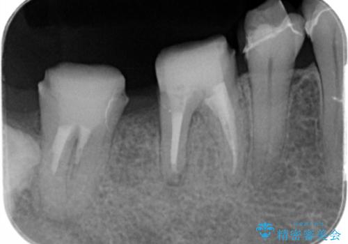 歯周病の歯を残すための再生治療の治療後