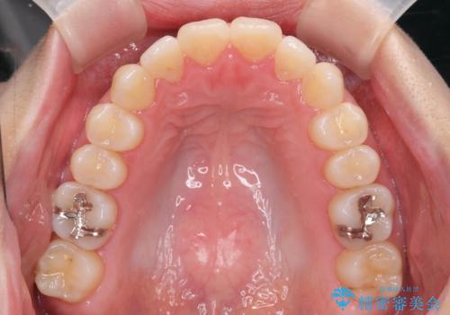不安定な噛み合わせを改善 マウスピース矯正治療の治療後