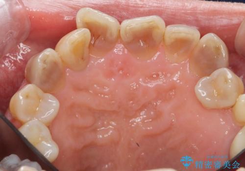 [ テトラサイクリン歯 ] 長年気になっていた変色歯を改善の治療前