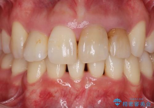 変色した歯を改善、セラミック治療の治療前
