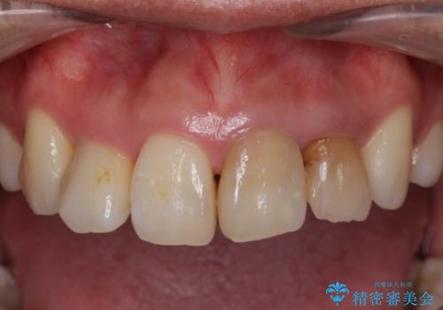 変色した歯を改善、セラミック治療の治療前