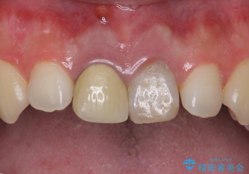 前歯の変色 神経のない歯の再治療の治療前