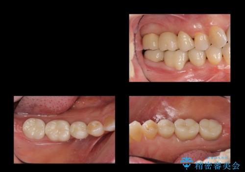 奥歯の高さがない　歯周外科で解決の治療後