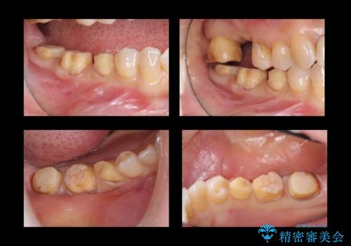 奥歯の高さがない 歯周外科で解決の治療中