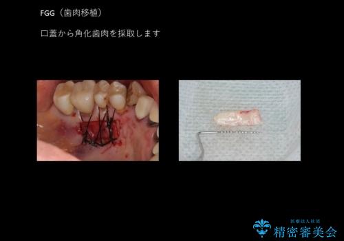 奥歯のインプラント 永くもつようにの治療中