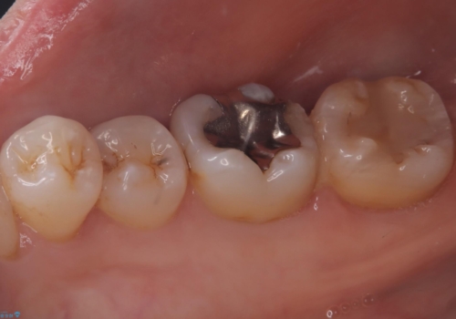 【セラミックインレー】歯と歯の間に物がよく詰まるの治療前