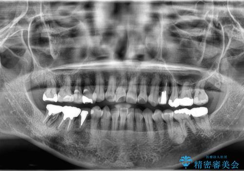 毎食後物がつまる! インプラント治療の治療前