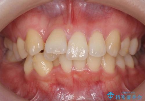 やや難ケース 上の歯を抜かずに歯列を後ろに下げて治療 4本ではなく下1本のみの抜歯できれいにの症例 治療前