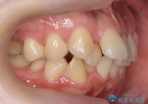やや難ケース　上の歯を抜かずに歯列を後ろに下げて治療　4本ではなく下1本のみの抜歯できれいにの治療前