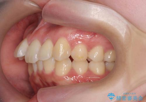 やや難ケース 上の歯を抜かずに歯列を後ろに下げて治療 4本ではなく下1本のみの抜歯できれいにの治療前