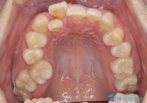 やや難ケース 上の歯を抜かずに歯列を後ろに下げて治療 4本ではなく下1本のみの抜歯できれいにの治療前