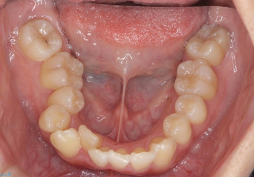 やや難ケース 上の歯を抜かずに歯列を後ろに下げて治療 4本ではなく下1本のみの抜歯できれいにの治療前
