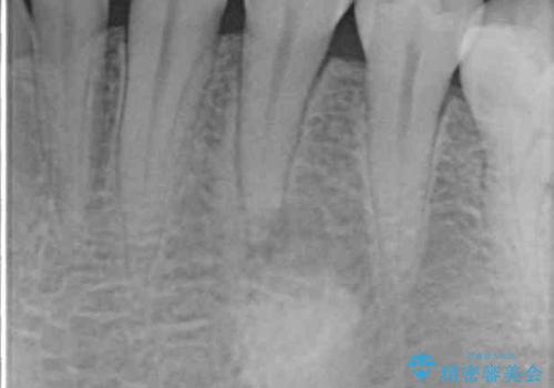 痛みでうずく 根管治療と補綴治療の治療前