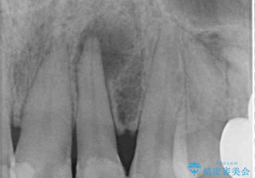 根元がうずく前歯 根管治療とオールセラミック治療の治療前