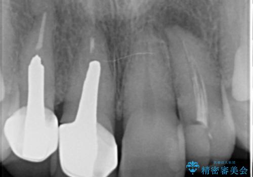 前歯のかぶせもののやり直し、根の治療もの治療前