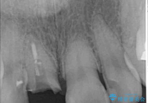 折れてしまった前歯   オールセラミックによる審美改善の治療前