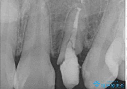 抜歯と言われた前歯 牽引してセラミッククラウンで保存するの治療前